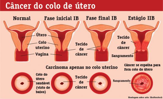 cancer-de-utero